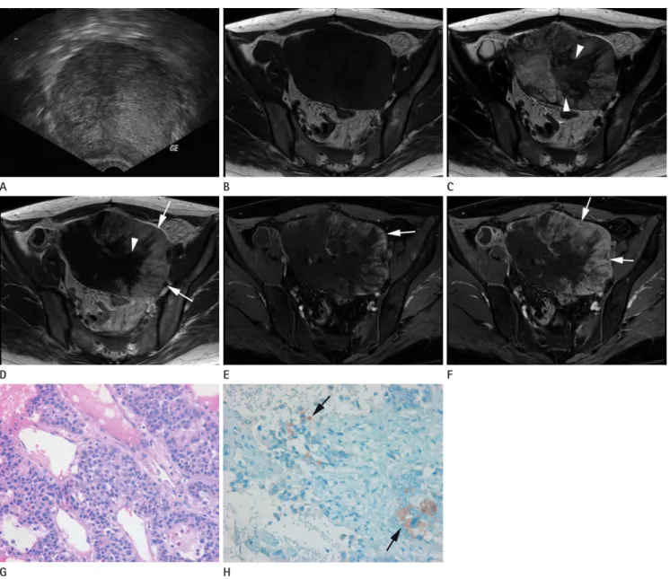 Fig. 1. A. Transvaginal USG image shows a huge heterogeneous echoic mass in pelvic cavity.