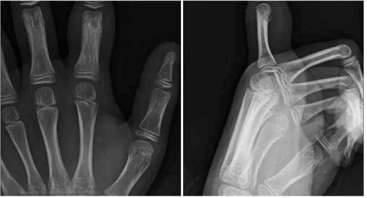 Fig. 1. AP (A) and lateral (B) plain radiographs show a well-defined exophytic osseous mass arising from volar aspect of the right 2 nd  proximal  phalanx shaft