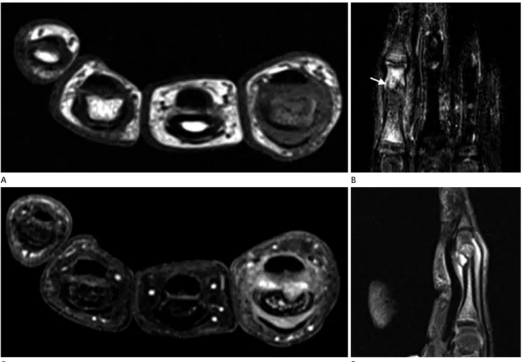 Fig. 3. Upon microscopic examination, the mass shows a mixture of hypercellular cartilage maturing to trabecular bone with a classic irregular  chondro-osseous interface