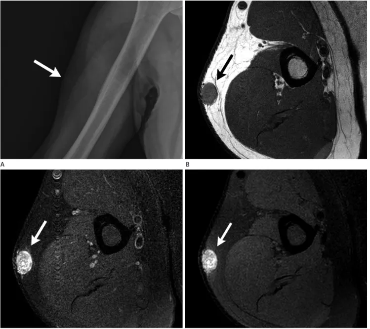Fig. 1. A. A plain radiograph of the right humerus showing a soft tissue nodule (arrow).