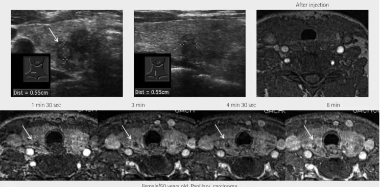 Fig. 3. On ultrasonography, an approximately 5 millimeter, well hypoechoic nodule (arrow) is seen in the right lobe of the thyroid gland at mid  level