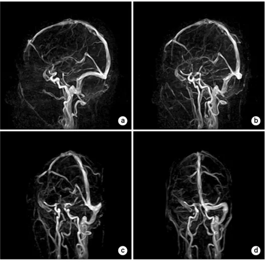 Fig.  8.  3D  PC  MRA  targeted  on  superior  sagittal  sinus  images  of  25-year-old  normal  male  volunteer