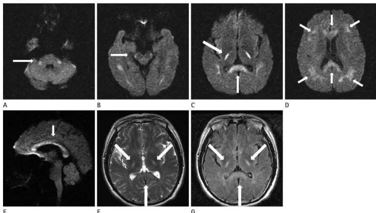Fig.  1.  Axial diffusion-weighted magnetic resonance images obtained upon admission show symmetrical hyperintense lesions involving the  middle cerebellar peduncle (A), corticospinal tract (B), posterior limb of internal capsule and the splenium of the co