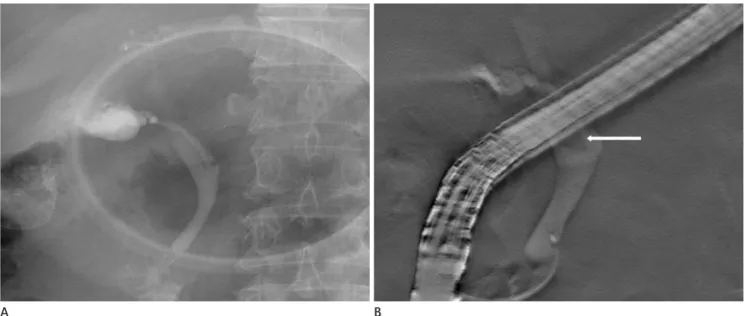 Fig. 3. A 70-year-old man with one stone in the proximal CBD.