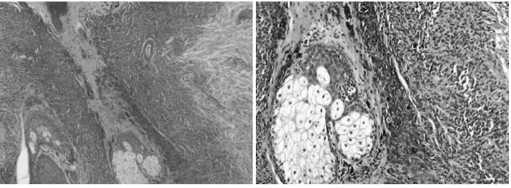 Fig. 2. Histopathologic findings show that nevus cells are present near and around appendages and the deep dermis (A