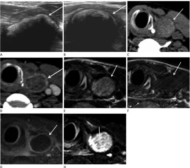 Fig. 1. 43-year-old man with gossypiboma in left thyroid bed, which is found 7 months after total thyroidectomy.