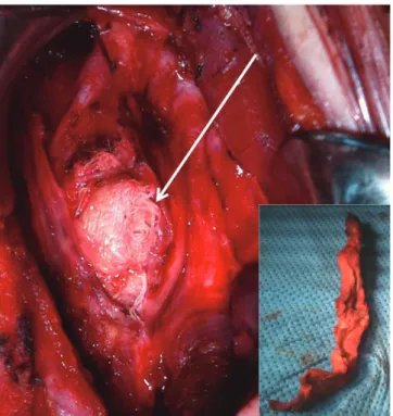 Fig. 2. Retained surgical sponge (arrow) in the left side of the thyroid  bed. 