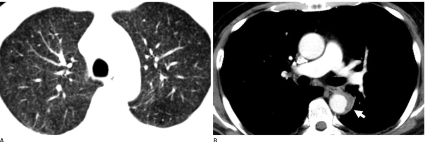Fig. 1. Tuberculous aortitis of the descending thoracic aorta in a 56-year-old man.