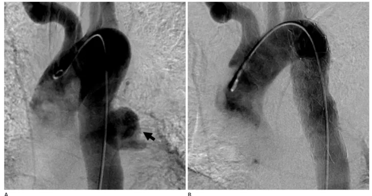 Fig. 2. A tuberculous pseudoaneurysm of the descending thoracic aorta in a 56-year-old man.