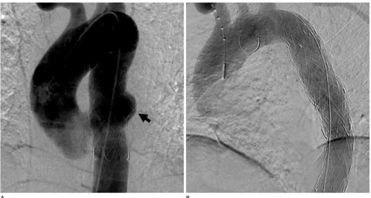 Fig. 4. A tuberculous pseudoaneurysm of the descending thoracic aorta treated with an aortic stent graft in a 56-year-old man.