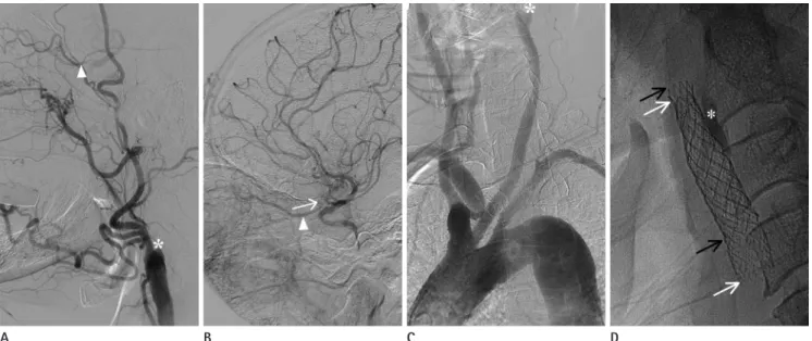 Fig. 1. A 69-year-old man with a symptomatic carotid stump.