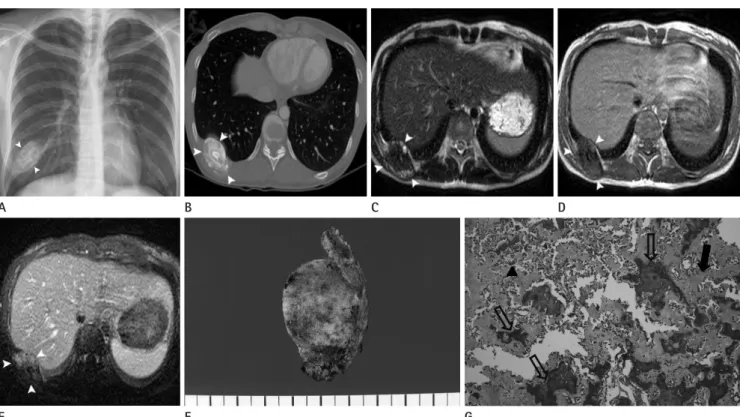 Fig. 1. Radiograph, CT, MRI, and histopathologic specimen images of 31-year-old woman with osteoblastic osteosarcoma of the rib.