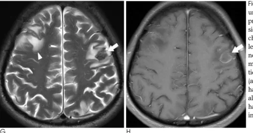 Fig. 1. G, H. The brain MRI with gadolini- gadolini-um enhancement that was performed at presentation at the time of the last  admis-sion