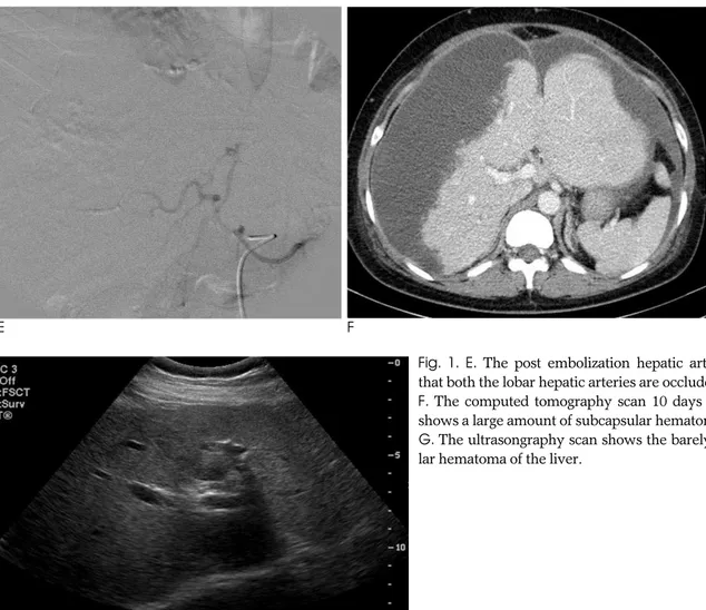 Fig.  1.  E.  The post embolization hepatic arteriogram showing that both the lobar hepatic arteries are occluded.