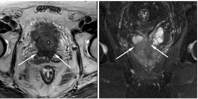 Fig. 2. A 76-year-old man with PSA of 4.946 and high probability of seminal vesicle invasion suggested by 3.0T SVM model.
