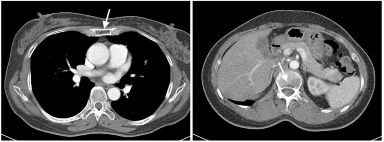 Fig. 4. A, B. Follow-up CT scan after 4years shows nearly normalized sternal body, L1 body, and sacrum (arrow).