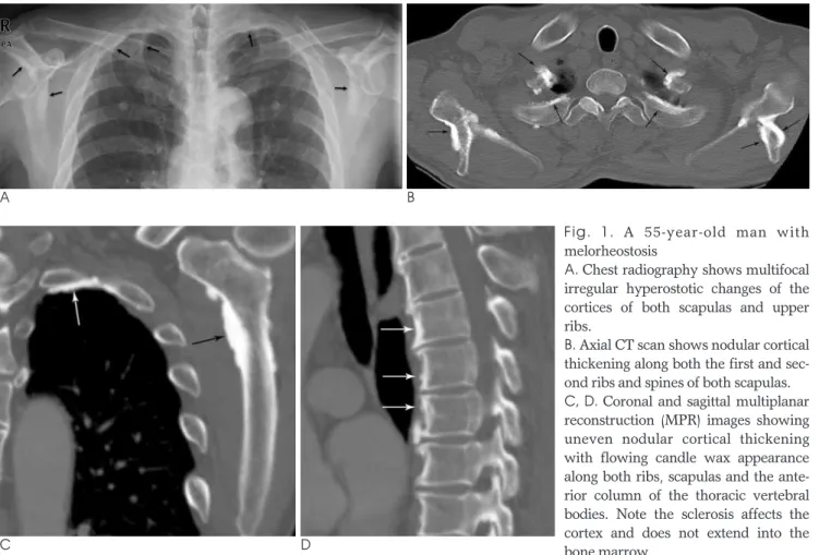 Fig.  1.  A 55-year-old man with melorheostosis 
