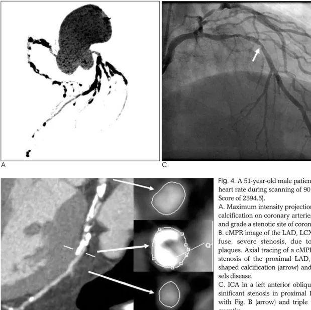 Table 4. Diagnostic Accuracy of Dual Source CT Coronary Angiography Per Vessel According to Agatston Scores