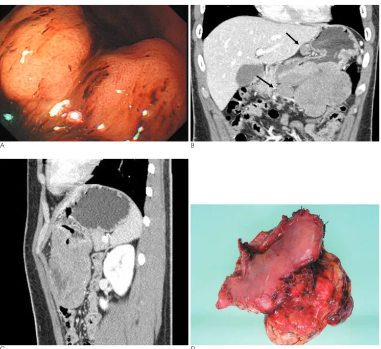 Fig. 1. Peripheral primitive neuroectodermal tumor of the stomach in a 22-year-old man.