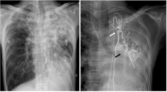 Fig. 1. A. Chest X-ray shows advanced pulmonary tuberculosis. 