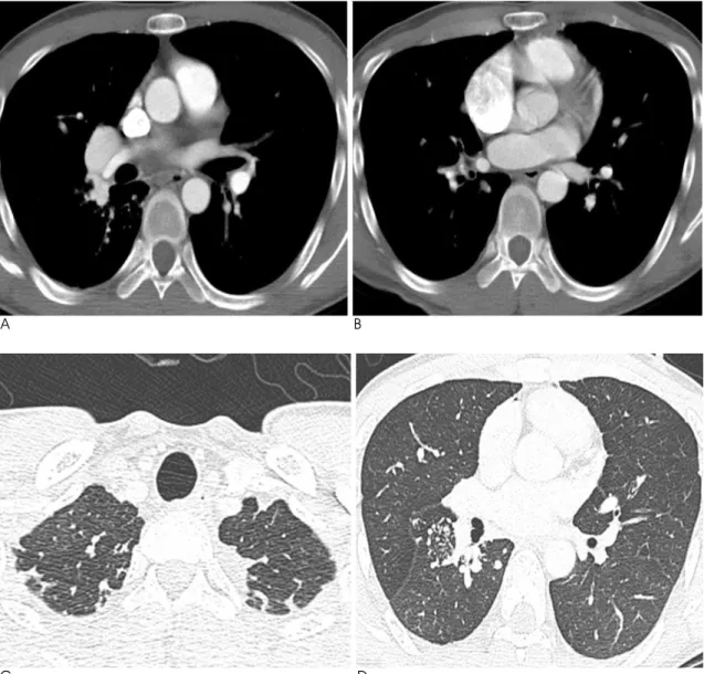 Fig. 3. Contrast-enhanced CT scan shows markedly a dilated right superior pulmonary vein (A) without connection to the left atri- atri-um (B), and multiple nodules suggesting collateral vascular structures in the pleural area of both upper lung zones (C) a