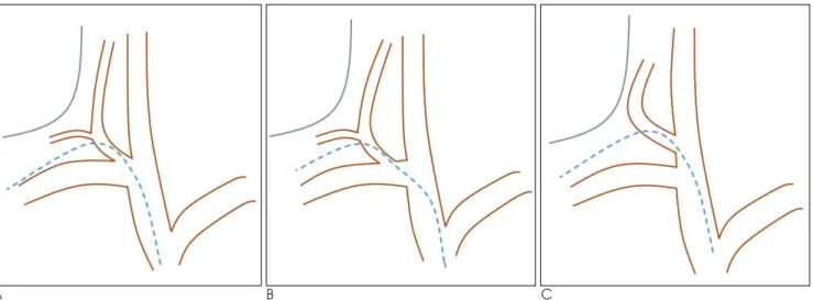 Fig. 1. Anatomic variations of the external jugular vein. 
