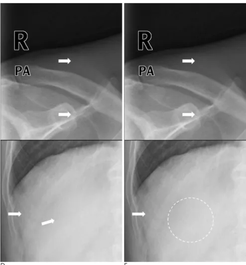 Fig. 1. At a compression level of 15:1 (D), vertical linear artifact appears in the right part of the image (arrows)