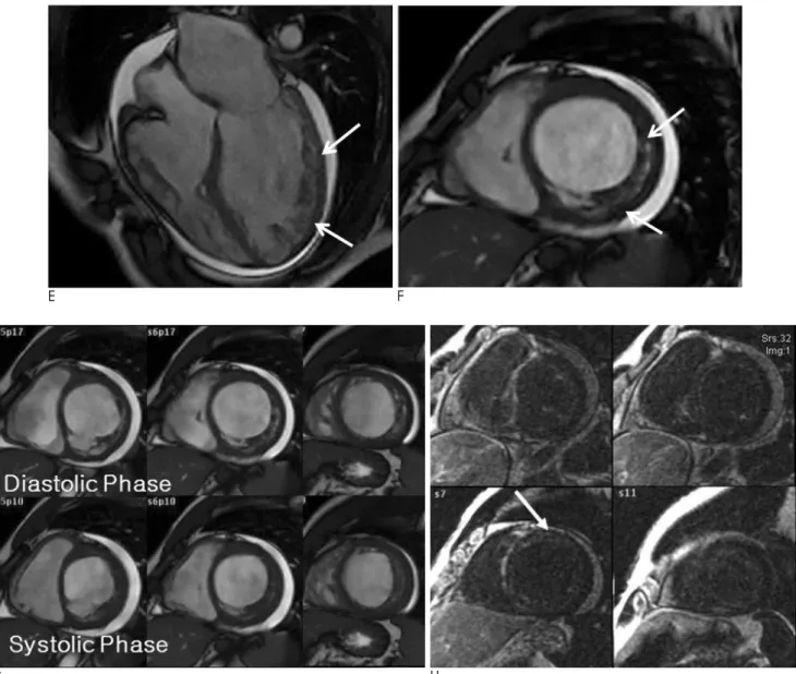 Fig. 1. E. Static 4-chamber view of cine MR image showed prominent ventricular myocardial trabeculations and deep intertrabecu- intertrabecu-lar recesses communicating with the ventricuintertrabecu-lar cavity, compromising the mid-ventricuintertrabecu-lar 