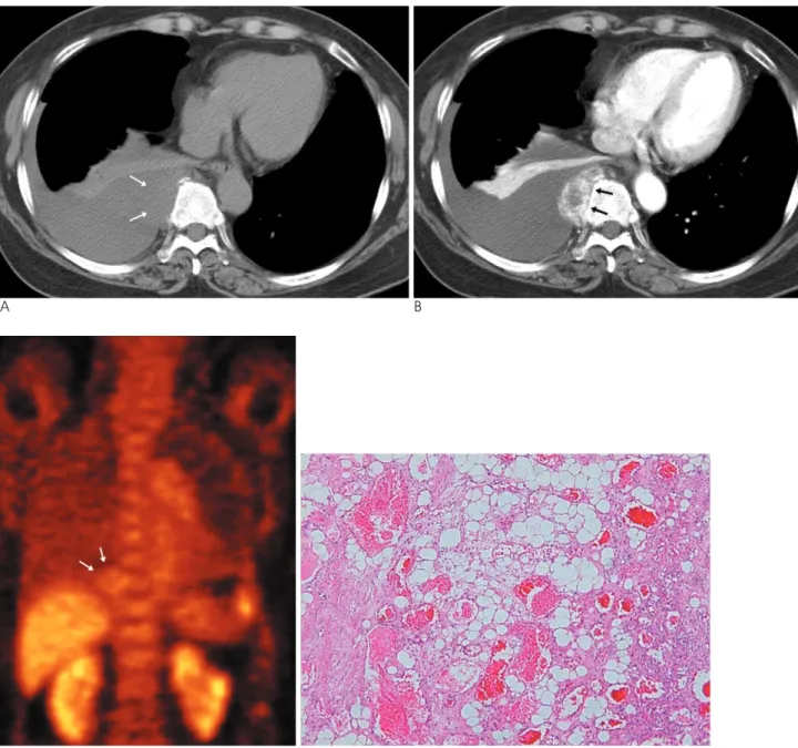 Fig. 1. Posterior mediastinal angiolipoma in 66-year-old woman.