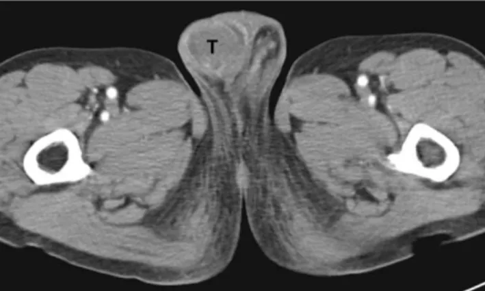 Fig. 4. Follow-up pelvic CT scan after 8 months.