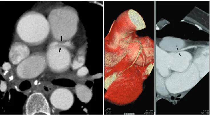 Fig. 3. A, B. The MPR image (A) and 3-dimensional volume-rendering images (B) show the compression of the left main coronary artery (arrows) by the LC-SVA.