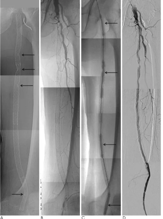 Fig. 3. A, B. 72-year-old man with type I and II stent fractures (arrows) with total occlusion of SFA at 16 months  af-ter placement of four stents in the SFA and the popliteal artery