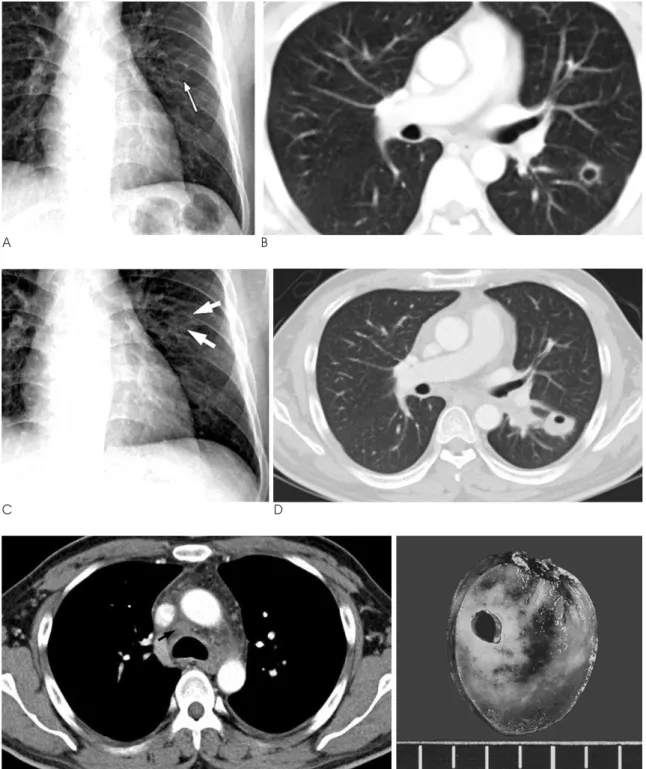 Fig. 1. A. The initial chest X-ray of a 39-years-old male shows a thin-walled cavitary lesion (arrow) in the left middle lung zone