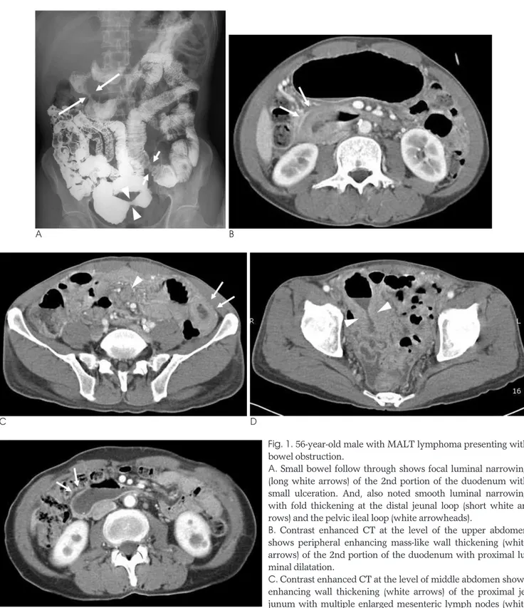Fig. 1. 56-year-old male with MALT lymphoma presenting with bowel obstruction.