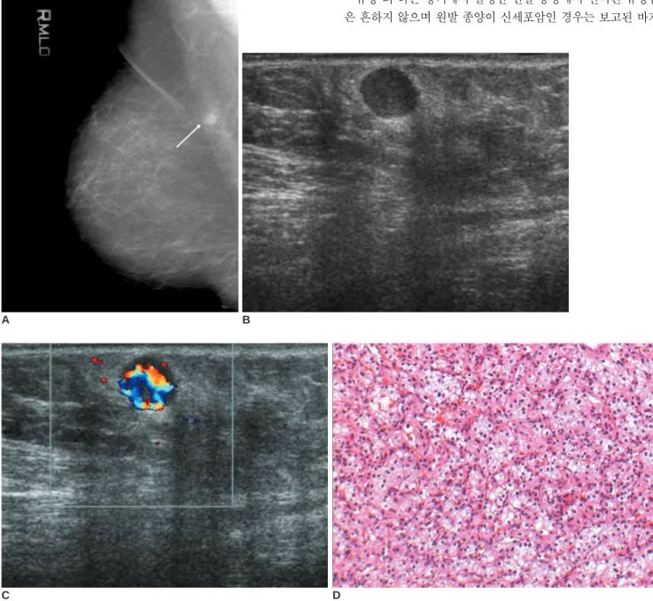 Fig. 1. A 63-year-old woman with metastatic breast cancer from renal cell carcinoma.