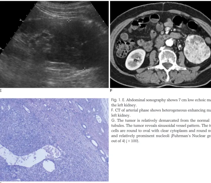 Fig. 1. E. Abdominal sonography shows 7 cm low echoic mass in the left kidney.