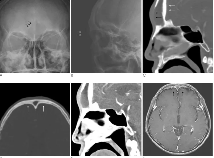 Fig. 1. 64-year-old man complaining of diplopia, blurred vision, and mild tenderness on the glabellar area.