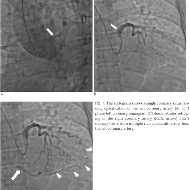 Fig. 1. The aortogram shows a single coronary sinus (arrow) and only opacification of the left coronary artery (A,  B)