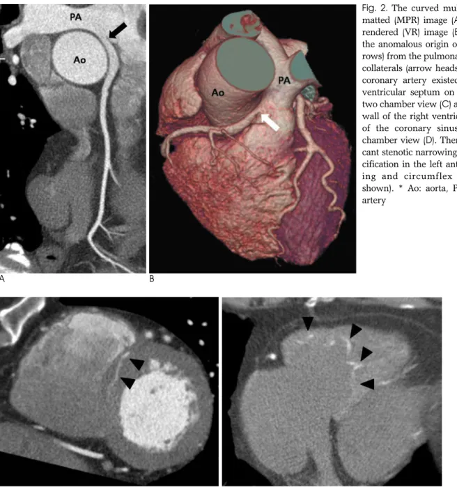 Fig.  2.  The curved multiplanar refor- refor-matted (MPR) image (A) and volume rendered (VR) image (B) demonstrate the anomalous origin of the RCA  (ar-rows) from the pulmonary trunk