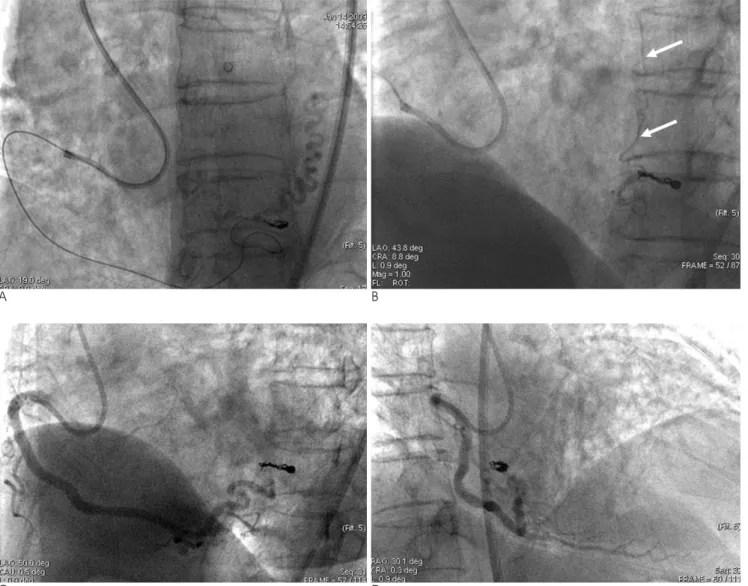 Fig. 3. Coronary-to-bronchial anastomosis was treated with transarterial microcoil embolization (A)
