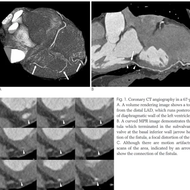 Fig. 1. Coronary CT angiography in a 67-year-old male patient. 