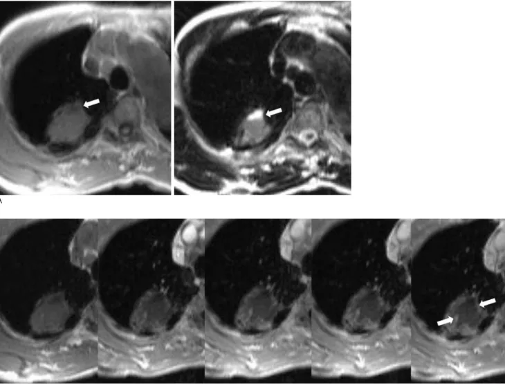 Fig. 3. Atypical PMF in a 66-year-old man had worked as a coal miner for 23 years. 