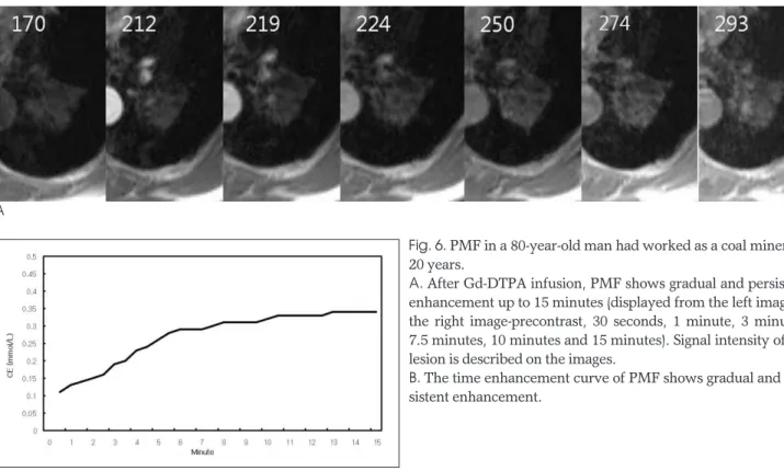 Fig. 6. PMF in a 80-year-old man had worked as a coal miner for 20 years.