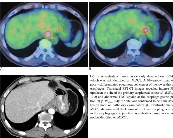 Fig.  3. A metastatic lymph node only detected on PET-CT, which was not identified on MDCT
