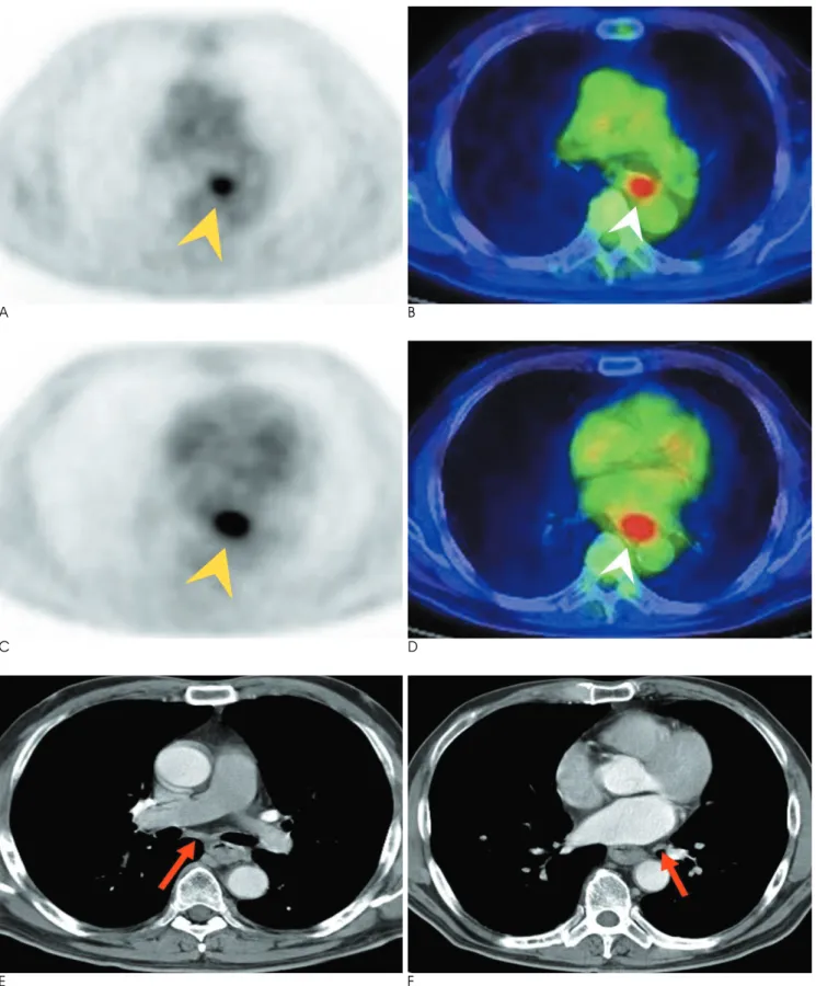 Fig. 4. False-negative loco-regional metastatic lymph nodes on PET-CT. A 66-year-old man with poorly differentiated squamous cell cancer of the lower esophagus