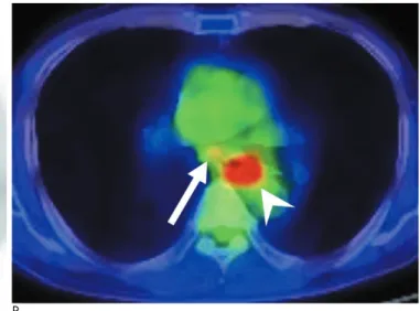 Fig. 5. False-positive metastatic lymph node on PET-CT in a 60- 60-year-old male with poorly differentiated squamous cell  carcino-ma of the mid- to lower esophagus