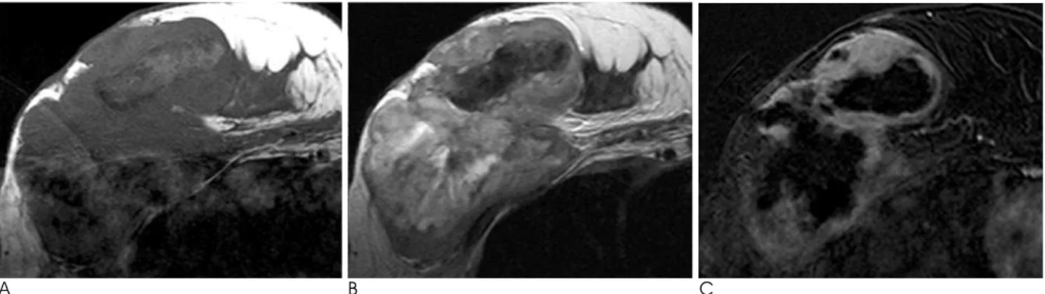 Fig. 3. On the gross specimen, the tumor mass has a relatively well-delineated and lobulating margin, and the mass measures 16×12×6 cm