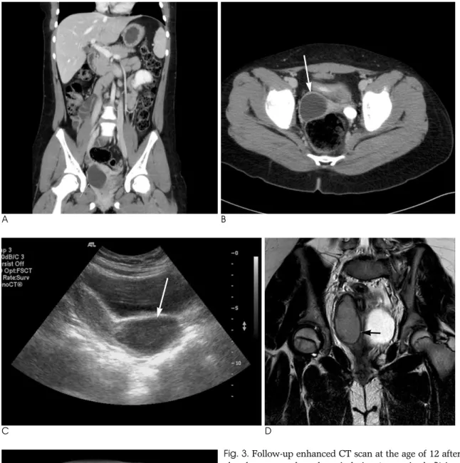 Fig. 3. Follow-up enhanced CT scan at the age of 12 after menar- menar-che shows an enlarged cystic lesion (arrow in A, B) in the right pelvic cavity, as compared with a previous examination,  sugges-tive of hematocolpos