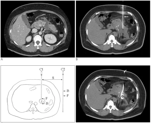 Fig. 1. Steps of CT-guided catheter placement for deep-seated small fluid collection using modified Seldinger technique.