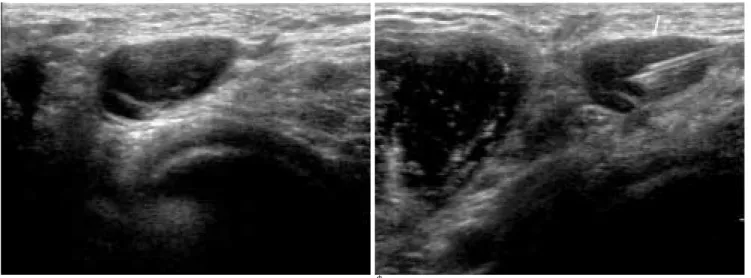 Fig. 3. Tuberculosis in a 50-year-old women. 